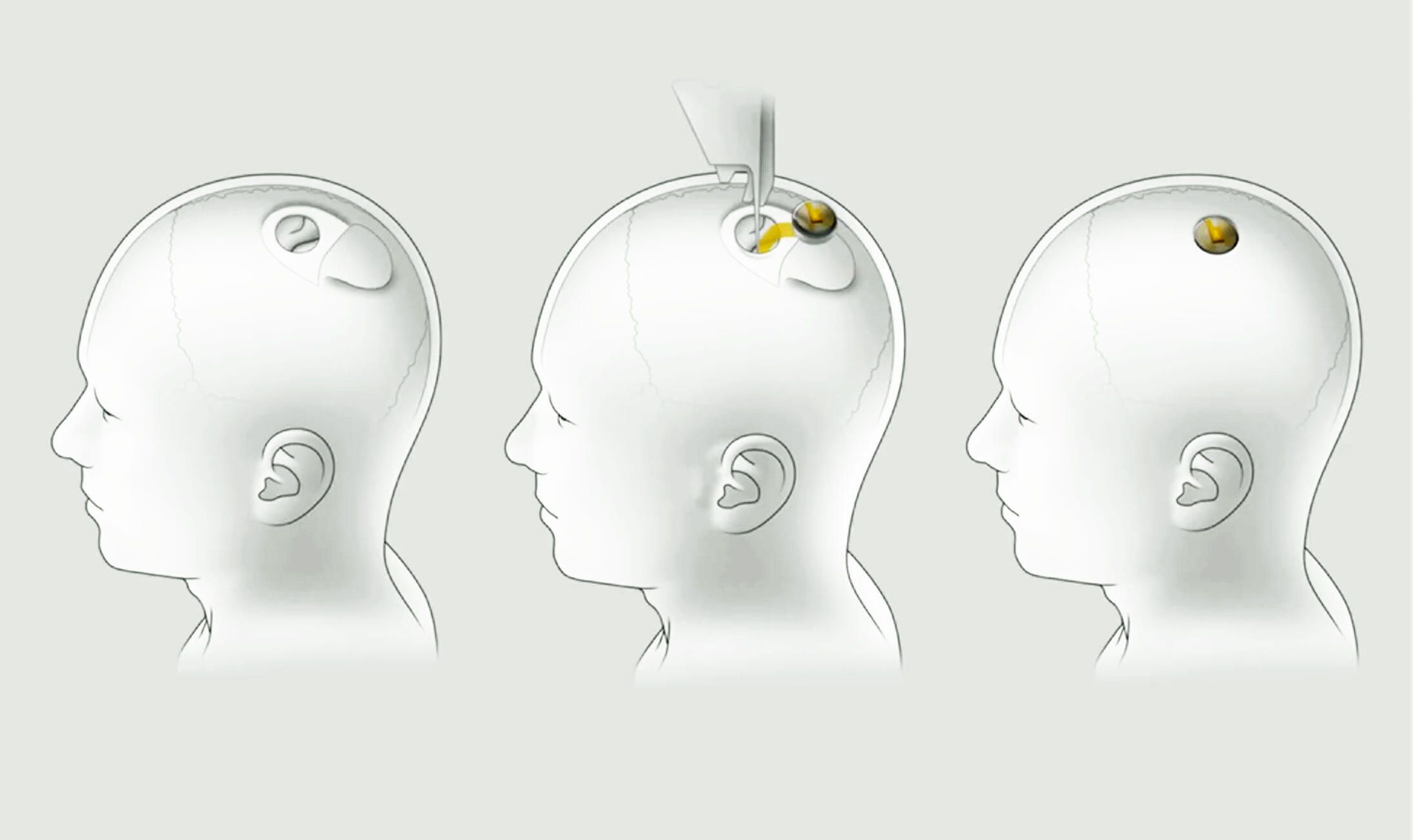 The device was developed by Neuralink , a company owned by Musk himself, which is creating the technologies needed to develop a brain-computer interfa